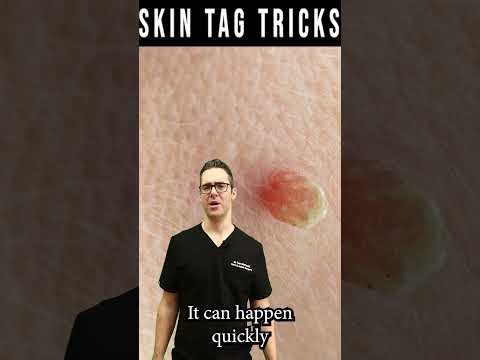 Skin Tag Removal & Plantar Wart Removal [Garlic, Iodine & Cider]