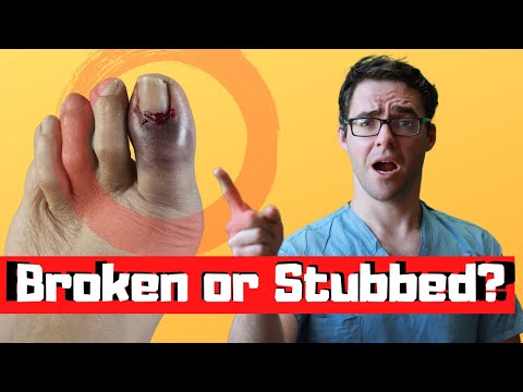 Stubbed Toe or Broken Toe?  [Symptoms, Pain Relief & Treatment!]