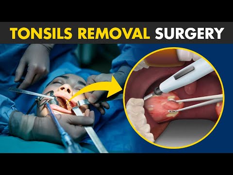 How Tonsillectomy Procedure Is Performed? | Tonsils Removal Surgery (Tonsillectomy)
